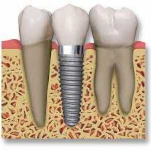 Zubni implantati: pacijent mišljenja kirurgija