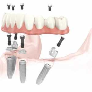Zubni implantati: kontraindikacije, stvarna šteta