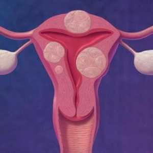 Međuprostorne fibroidi maternice - njegova karakteristična