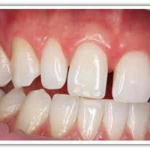 Malokluzija u odraslih. Zdravi zubi - lijepi zubi