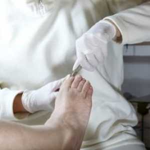 Učinkovito liječenje urastao noktiju na stopalima