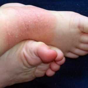 Ekcem na nogama: Simptomi i liječenje