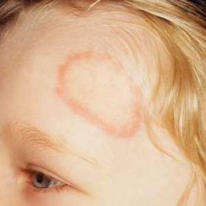 Kako i što liječiti lišajevi kod djece?