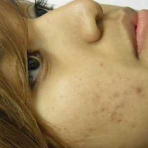 Kako da biste dobili osloboditi od acne ožiljaka?