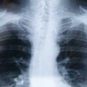Kako liječiti bronhitis bez antibiotika?