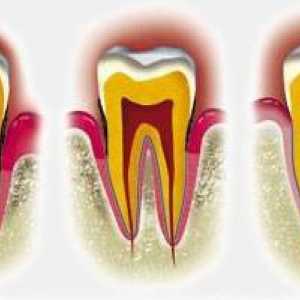 Kako liječiti parodontnih bolesti u ranim fazama bolesti