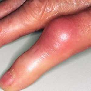Kako liječiti ljudi znači upalu zglobova prstiju
