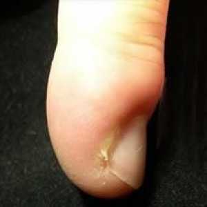 Kako liječiti žuljeva na prstima: različite terapije