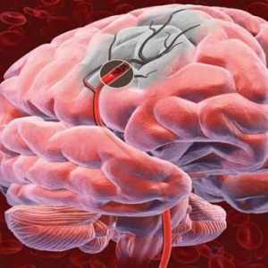 Kako odrediti moždani protok krvi: simptomi, liječenje