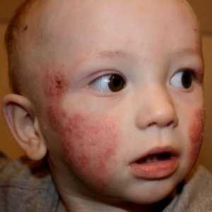 Kako kožnih bolesti u djece