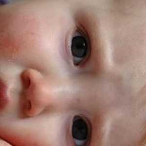 Kako je liječenje atopijskog dermatitisa u djece?