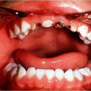 Zubni karijes u djece. Uzroci, liječenje, prevencija