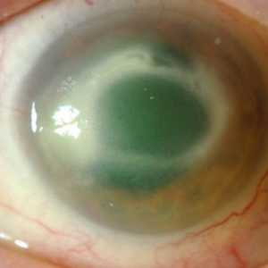 Keratitis očiju: znakovi, uzroci i liječenje