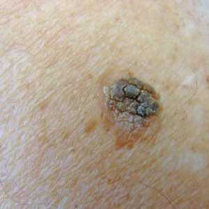 Keratomas - što je to? Liječenje kožnih keratomas