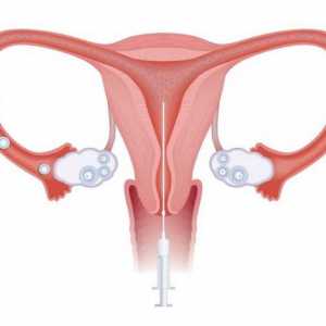 Kada se koristi intrauterini osjemenjivanje?