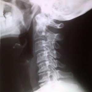 Gruda u grlu s osteochondrosis od vratne kralježnice: simptomi, liječenje