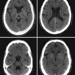 Kompjutorizirana tomografija mozga: Postupak ocjenjivanja