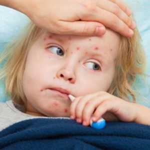 Ospice je dijete: Simptomi i liječenje