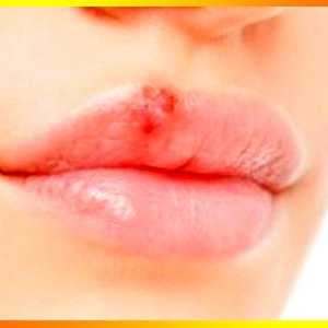 Lijevo herpes, ili kako se postupa hladno na usnama