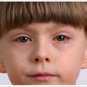 Crvene oči beba: uzroci, liječenje i prevencija