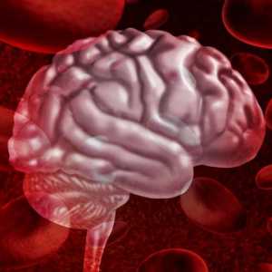 Krvarenje u mozgu: simptomi, liječenje, posljedice i prognoze