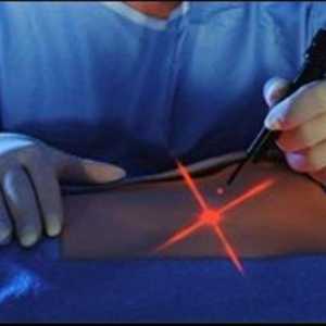 Laserska liposukcija