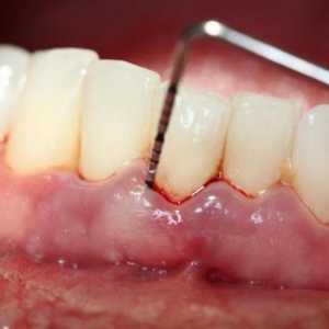 Liječenje parodontitisa u kući narodnih lijekova (recenzija)