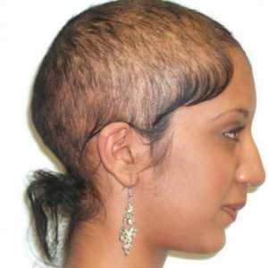 Da li postoji lijek androgena alopecija? Uzroci gubitka kose. transplantacija kose