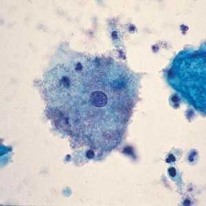 Povreda mikroflore vagine: uzroci i simptomi