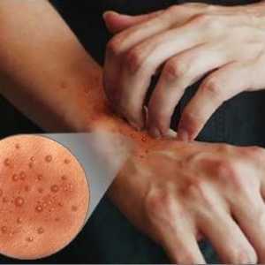 Atopijski dermatitis na rukama: etiologija, klinička obilježja tretmana