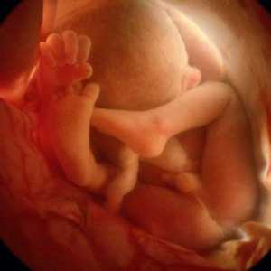 Zaplitanja pupčanu vrpcu oko vrata fetusa: kao što je to opasno?