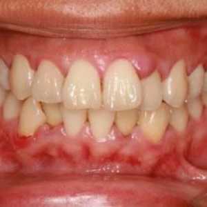 Natečene desni, ali zub ne boli - što učiniti? Uzrokuje oticanje desni i liječenje