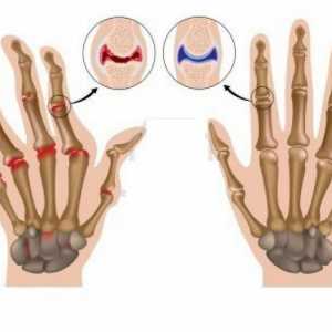 Obilježja statusa i liječenju bolesnika s reumatoidnim artritisom