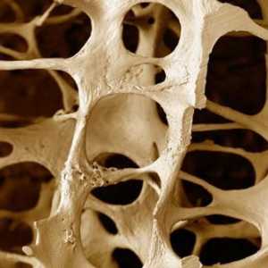 Osteoporoza. Što je to patologija?