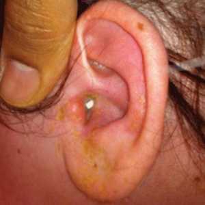 Otitis media uho: liječenje, simptomi i uzroci