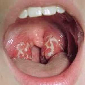 Gdje aureus u grlu. simptomi infekcije