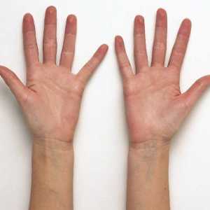 Odgovori na pitanje „zašto je znojenje ruku?”