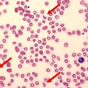 Patološki hemolizu krvi: uzroci, simptomi i tretmani
