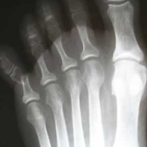 Frakture prstiju: uzroci, simptomi i tretmani