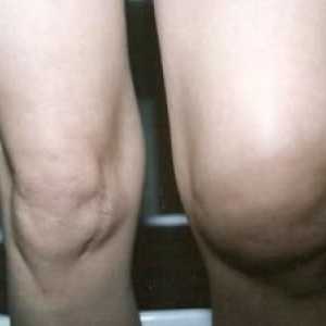 Zašto koljena bubri i bolovima? Uzroci i liječenje