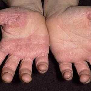 Zašto gljivica kože na svojim rukama i kako ga izliječiti?