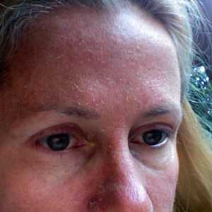 Zašto ljuskava koža na licu? Uzroci i liječenje