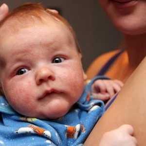 Zašto novorođenče zagnojiti oči?