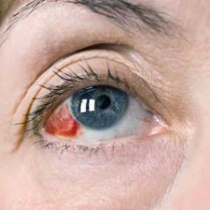 Zašto praska krvne žile u očima: uzroci i liječenje