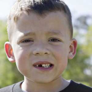 Pocrnjeli zubi - što učiniti? Pocrnjeli zubi u djece