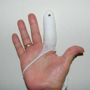 Detalji o tome kako razbiti prst na ruci ili nozi