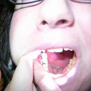 Korisne informacije: alveolitis nakon vađenja zuba
