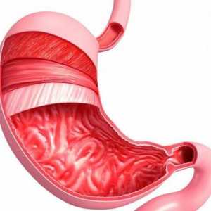 Površna gastritis: što je to? Uzroci, simptomi i tretman metode