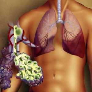 Pravo-sided upala pluća: uzroci, simptomi i tretman