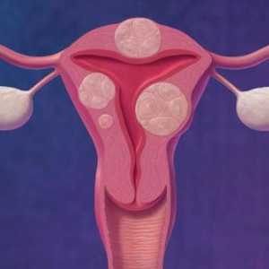 Uzroci mioma maternice i simptomi bolesti